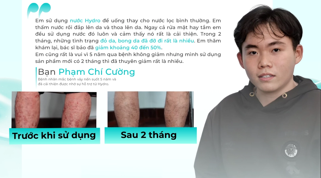 Cách trị bệnh vảy nến tại nhà bằng các loại nước lá dân gian 5 Nước Hydro hỗ trợ cải thiện tình trạng vảy nến hiệu quả