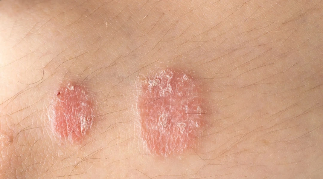 Cách trị bệnh vảy nến tại nhà bằng các loại nước lá dân gian 1 Tình trạng da đỏ bong tróc do bệnh vảy nến