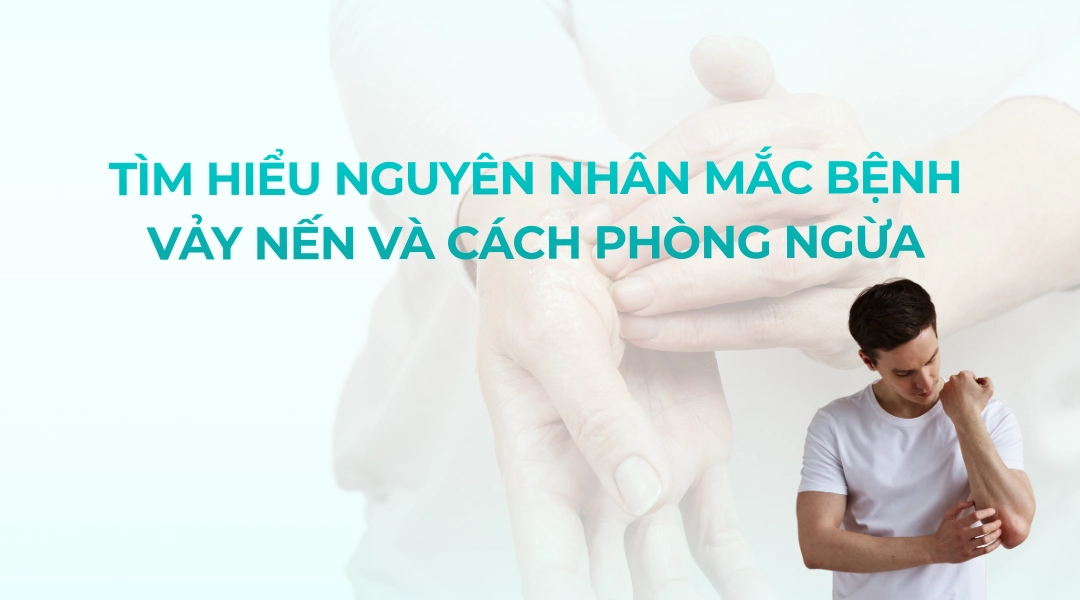 Nguyen nhan mac benh vay nen va cach phong ngua hieu qua