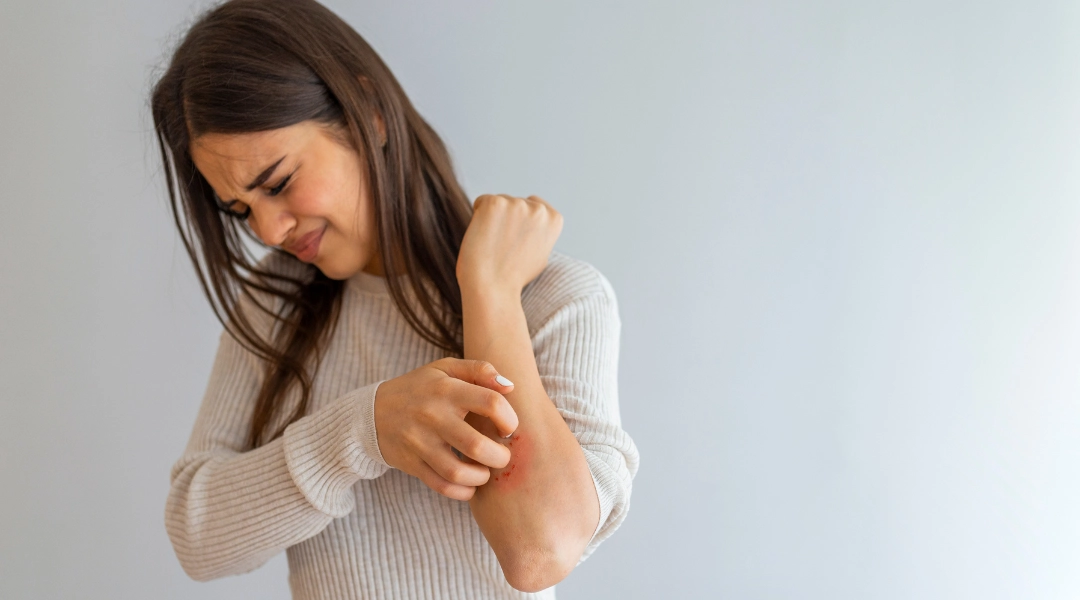 Nguyên nhân mắc bệnh vảy nến và cách phòng ngừa hiệu quả 1 Bệnh vảy nến và nguyên nhân