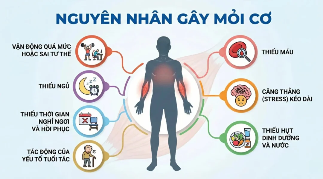 nfographic nguyên nhân gây mỏi cơ: tập luyện quá mức, mất nước, thiếu khoáng chất và căng thẳng